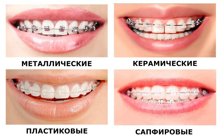 Керамические брекеты Томск Мирная стоматологические клиники в томске цены